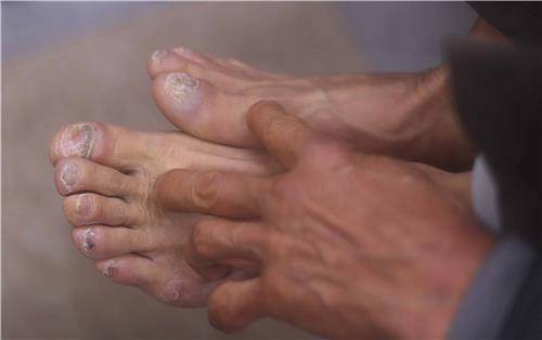 납중독 노동자 발 (창원=연합뉴스) 김동민 기자 = 27일 경남도 프레스센터에서 열린 기자회견에서 납중독 노동자 정모씨가 자신의 발을 공개하며 육체적인 피해를 알리고 있다.