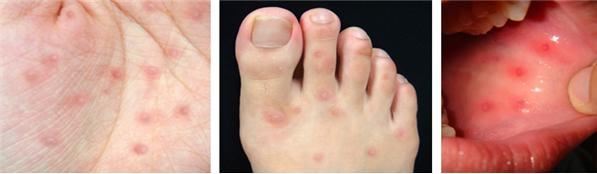 수족구병에 의해 손과 발, 입안에 수포성 발진이 일어난 사례. 질병관리본부 제공