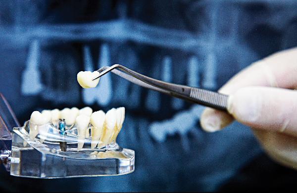 임플란트를 심은 후에는 치아 관리에 특별히 신경 쓰지 않으면, 치아가 다시 흔들려 빠지기 쉽다./사진=헬스조선 DB