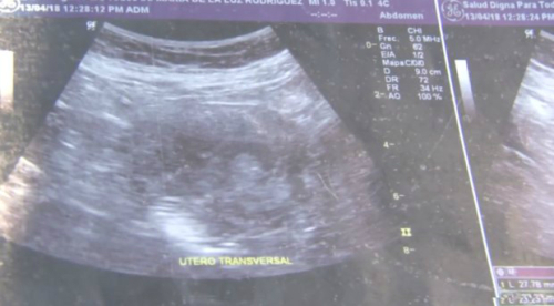 초음파 사진. 의사들은 처음부터 임신으로 확인했지만 오진일 가능성이 매우 커 10회에 이르는 검사를 진행했다.