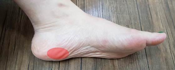 발의 아치를 유지하고 충격을 흡수하는 역할을 하는 족저근막이 손상되면서 통증이 생기는 질병인 족저근막염(足底筋膜炎). [사진 유재욱]