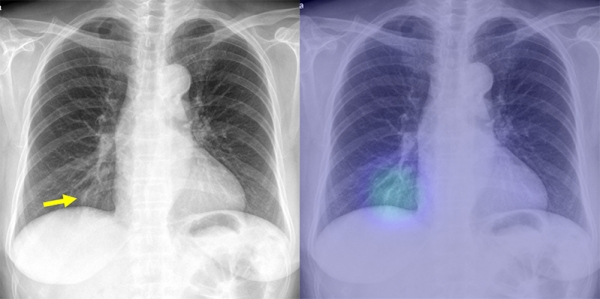 ⓒ서울대병원=일반 흉부X선 사진과 인공지능 시스템이 확인한 사진(오른쪽). 우측 하부 폐의 폐암을 인공지능 시스템이 성공적으로 찾아냈다.&nbsp;