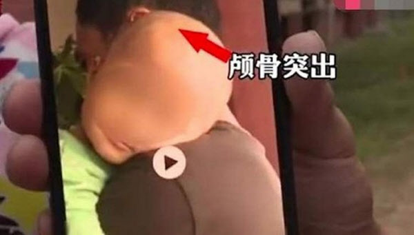 중국 후난성에서 발생한 가짜 분유 파동의 피해 아동 모습/신징바오