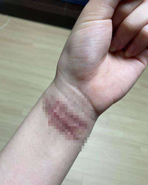 ▲ 권민아가 공개한 흉터 사진. 출처l권민아 SNS