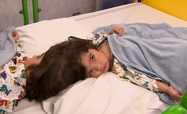 분리 수술 전인 샴쌍둥이 자매 사파 비비, 마르와 비비의 모습. /BBC