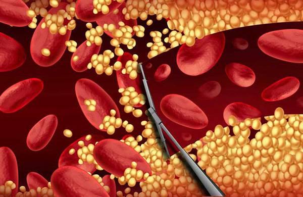 혈관은 하루아침에 청소되지 않으므로 꾸준하고 꼼꼼한 관리가 관건이다./사진=클립아트코리아