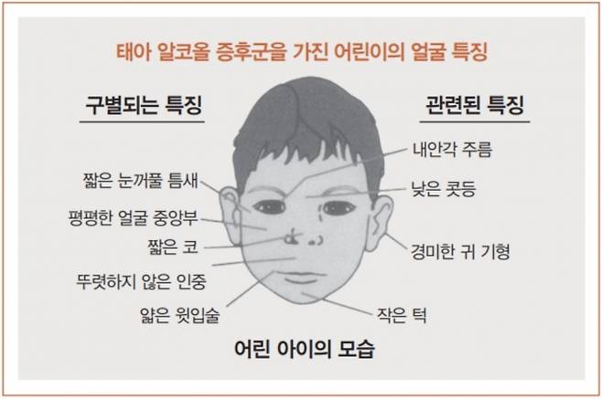 ▲태아알코올증후군을 가진 어린이의 얼굴 특징. 서적 '태아알코올증후군: 가정과 지역 사회를 위한 가이드'발췌.