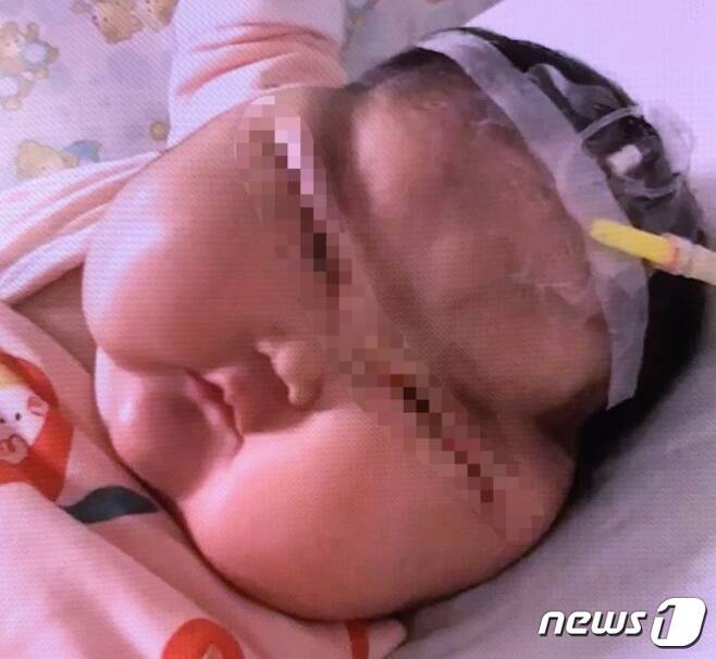 크림을 바른 아기에게서 얼굴 부종 증세가 나타났다.(신경보 갈무리)© 뉴스1