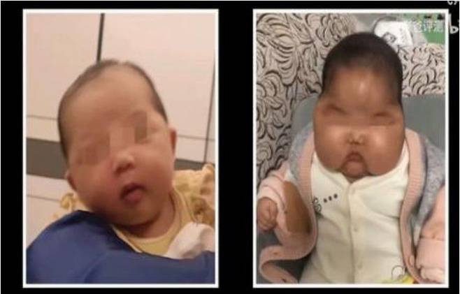 스테로이드 호르몬이 포함된 이른바 '저질 아기 크림'을 바른 아기(오른쪽)의 얼굴이 바르기 전보다 퉁퉁 부어있다. /트위터