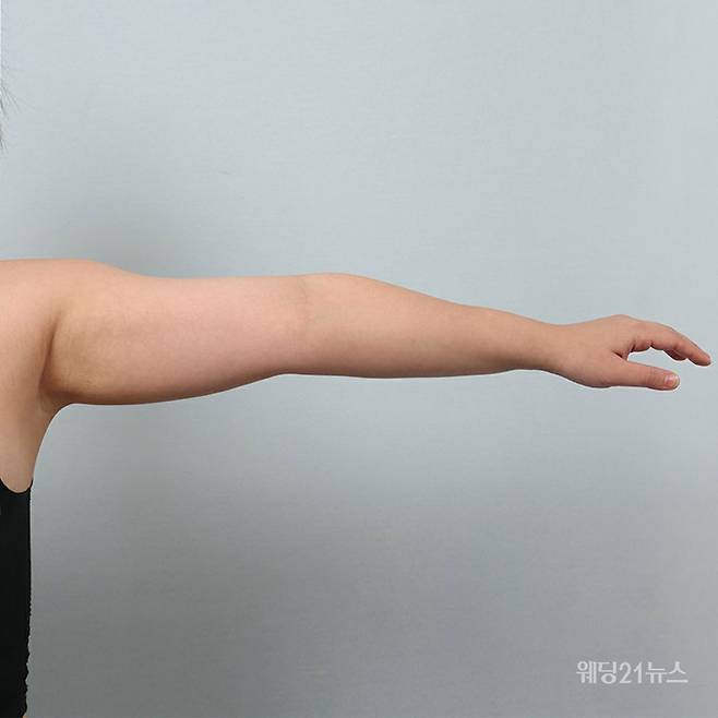 사진 : 약손명가코스메틱 바디 슬리밍 핫 크림 사용 전.