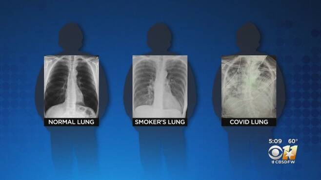 왼쪽부터 건강한 폐, 흡연자의 폐, 코로나 바이러스 감염자의 폐. /CBS DFW 보도화면