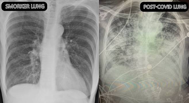 브리트니 뱅크헤드-켄달 박사가 제공한 폐 엑스레이 사진. 흡연자의 폐(왼쪽)과 코로나 바이러스 감염자의 폐. 엑스레이 상에서 폐의 검은 부분은 공기를 나타내고 흰 부분은 울혈이나 흉터를 뜻한다. /트위터