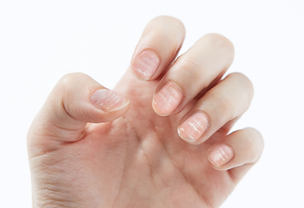 손톱에 가로로 나타나는 흰 줄은 아연 결핍 때문일 수 있다./사진=헬스조선 DB