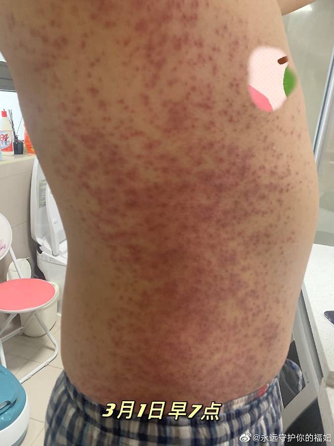 지난 1일 중국 SNS에 올라온 시노팜 백신 접종자의 온몸에 퍼진 붉은 반점 사진. [웨이보 캡처]