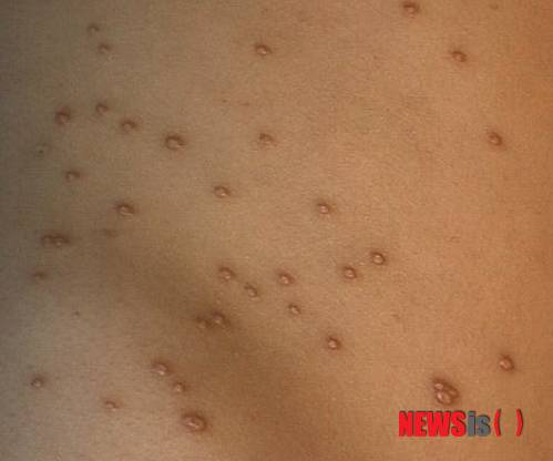 【서울=뉴시스】유희연 기자 = '유아 물사마귀'는 인유두종바이러스(HPV) 감염이 원인인 대표적인 바이러스성 피부질환으로 명절 이후 환자가 급증한다. 큰 일교차와 이동 중 생긴 피로로 인해 아이의 면역력이 급격히 떨어진 상태에서 바이러스가 쉽게 몸에 침투할 수 있기 때문이다. lovely_jh@newsis.com