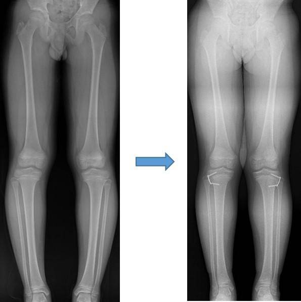반성장판 유합술로 내반슬(O다리)을 교정한 12세 남아의 수술 전후 엑스레이 영상