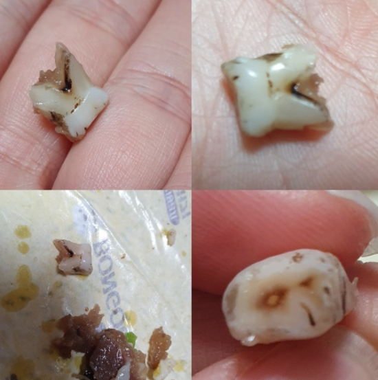 인천 서구의 유명 밥버거 전문점에서 판매하는 제품에서 이빨로 추정되는 이물질이 발견됐다. 사진=네이트판 게시판 캡처.
