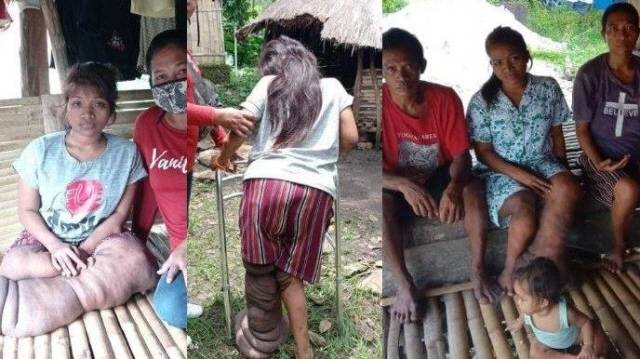 상피병을 앓고 있는 아나스타샤 아르논스 렌스./사진=트리뷴뉴스