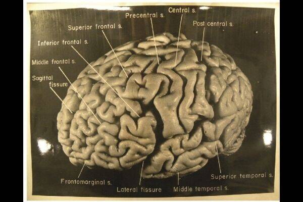 출처: Brain(2012)/National Museum of Health and Medicine