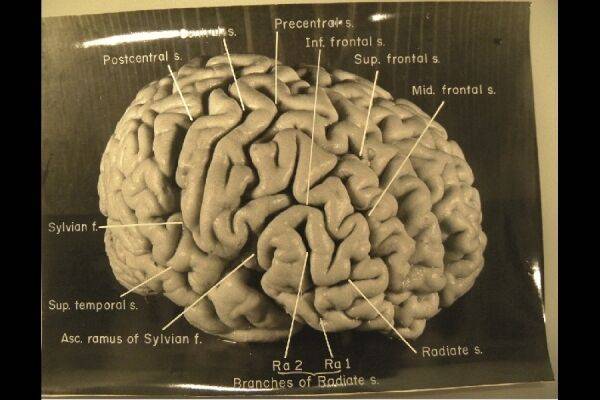출처: Brain(2012)/National Museum of Health and Medicine