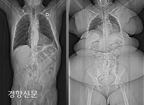 실제 정상체중(왼쪽)와 비만인 12살 소년(오른쪽)의 엑스레이 사진. /drbrianheer.wordpress.com