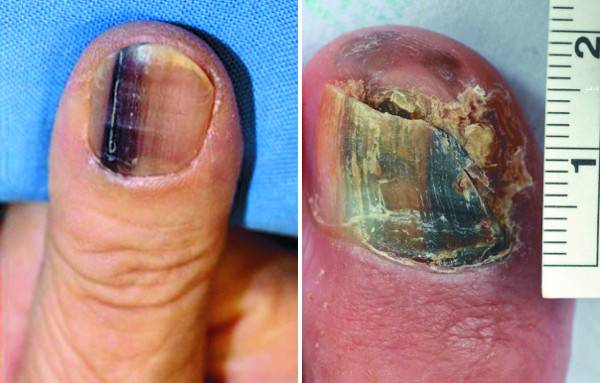 검은색 띠가 나타난 손톱 악성 흑색종의 초기 모습(왼쪽)과 림프절로 전이돼 모양이 변형된 발톱 흑색종. 서울대병원 피부암 협진센터 제공