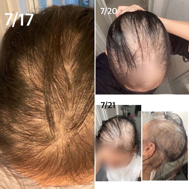 일본의 한 20대 여성이 신종 코로나바이러스 감염증(코로나19) 백신을 접종한 뒤 탈모 증세를 겪었다고 주장하고 나섰다. /사진=A씨 블로그 갈무리