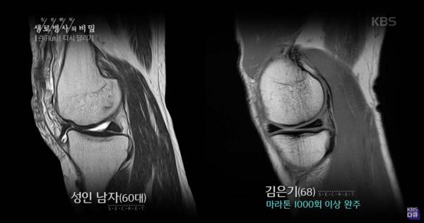 고려대 구로병원 정형외과 서승우 교수가 촬영한 마라톤을 하지 않은 60대 성인 남자의 무릎 자기공명촬영(MRI)사진(왼쪽)과 마라톤 1000회 이상 완주한 60대 남성의 무릎 MRI사진. 비교 결과 마라톤을 1000회 이상 한 남성의 무릎이 근육량도 많고 건강한 것으로 나타났다. 출처:KBS ‘생로병사의 비밀’ 방송화면 캡처