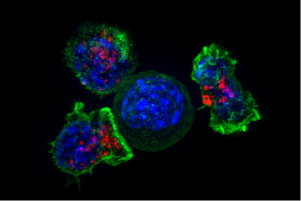 암세포(가운데)를 공격하는 3개의 킬러 티세포. 위키미디어 코먼스