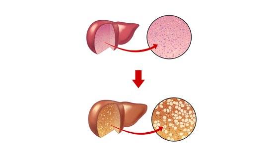 정상간과 비알코올성 지방간 모습. 사진 서울아산병원 제공