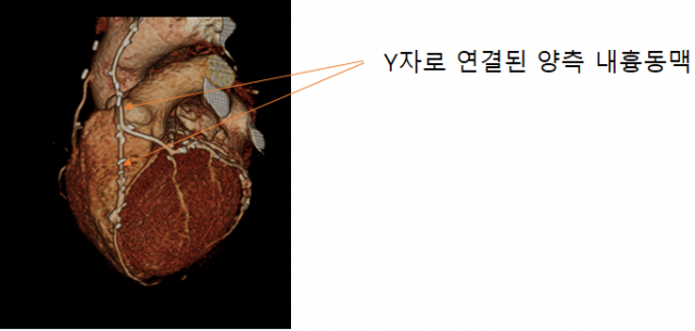 Y자로 연결된 양측 내흉동맥 컴퓨터단층촬영(CT) 사진 /사진 제공=삼성서울병원