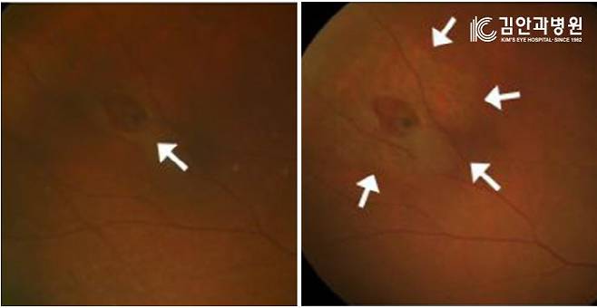 갑자기 심해진 비문증을 호소하며 안과를 방문한 환자의 망막 신경.