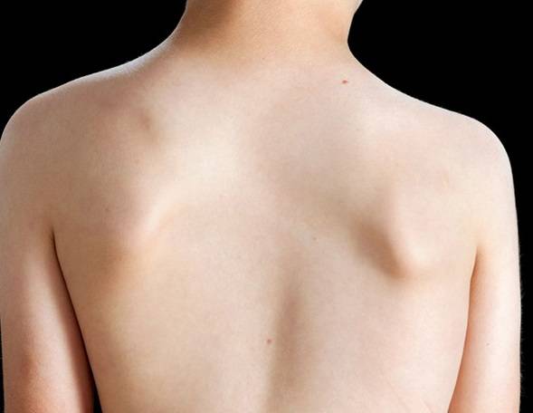 양쪽 어깨 높이가 다르다면 척추측만증을 의심할 필요가 있다./사진=클립아트코리아