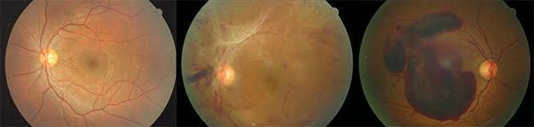정상인의 눈(왼쪽부터), 당뇨망막병증(출혈 및 증식막, 신생 혈관이 생긴 상태), 당뇨망막병증 환자의 눈. 대한한과학회 제공