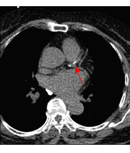 관상동맥 칼슘 컴퓨터 단층촬영(CT) 사진. 화살표가 가리키는 것이 칼슘이다. /사진 제공=삼성서울병원