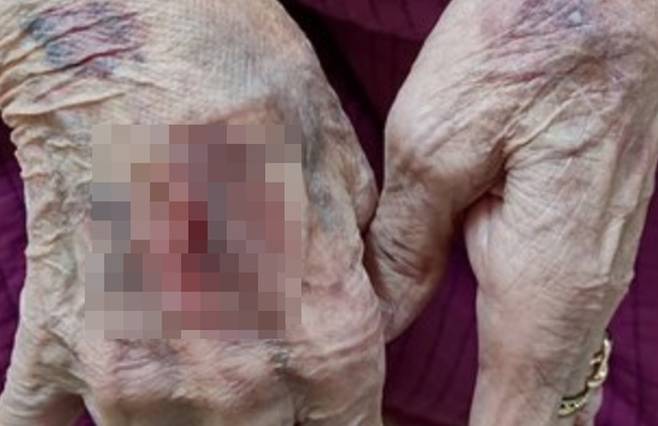 김천의 노인보호센터에서 할머니가 집단폭행을 당했다고 주장하는 손주가 공개한 피해 사진. 독자 제공