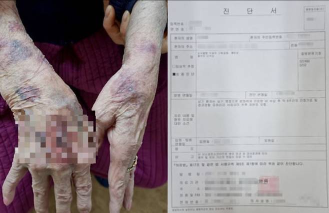 치매를 앓고 있는 자신의 80대 외할머니가 경북 김천시의 한 노인주간보호센터에서 집단폭행을 당했다고 주장한 게시글 작성자가 함께 올린 사진들. 온라인 커뮤니티 캡처