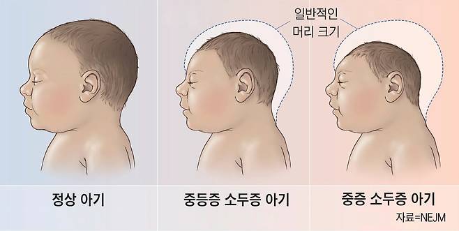 임신부가 지카 바이러스에 감염되면 나중에 태어난 아기의 뇌가 제대로 자라지 못하는 소두증이 발생한다. 정상 아기(왼쪽)에 비해 소두증 중등증(가운데)와 중증(오른쪽) 아기의 뇌가 훨씬 작은 것을 알 수 있다.