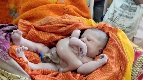 인도에서 팔, 다리가 각각 4개인 아기가 태어났다./사진=뉴스1