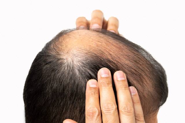 탈모약을 복용하고 나서 발기부전이 생겼다면 발기부전 치료제를 추가로 복용해도 된다. //게티이미지뱅크