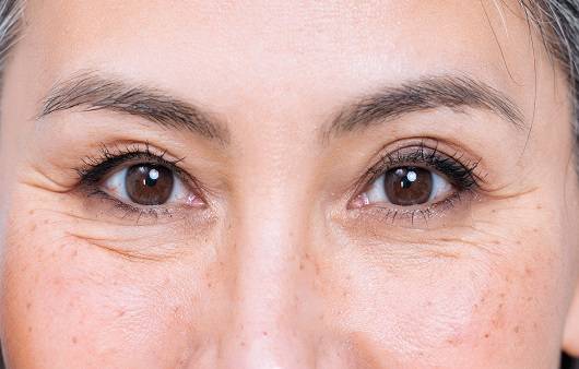 처진 눈을 개선하기 위해 이마눈썹거상술을 선택하는 사람이 늘고 있다