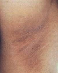 겨드랑이·목덜미 등이 까맣게 변하는 흑색가시세포증의 원인은 비만으로 체중만 감량해도 완화될 수 있다./사진=헬스조선DB