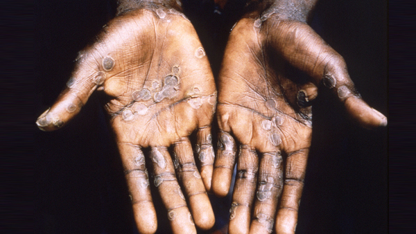 1997년 아프리카 콩고의 원숭이두창 환자 [자료사진: 연합뉴스 제공]