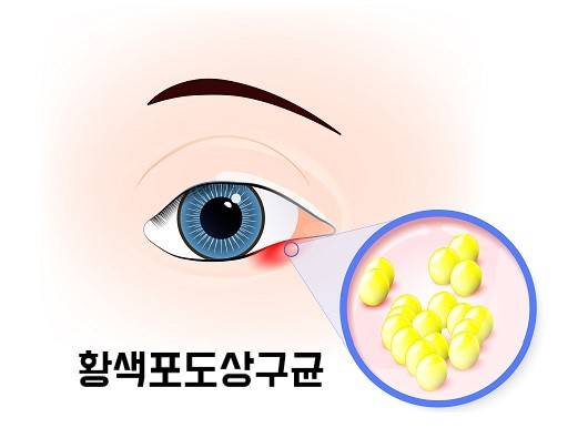 다래끼를 일으키는 황색포도상구균|출처:게티이미지 뱅크