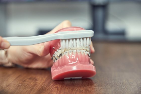 양치질을 할 때 교정기를 착용한 치아는 좌우로 살살 닦고, 교정기 위아래도 솔질해야 한다.