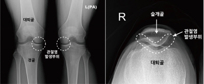 무릎관절염(좌)-슬개대퇴관절염(우) 발생 부위 비교. 사진제공|바른세상병원