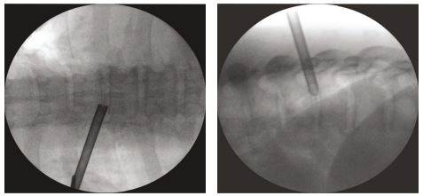 흉추 내시경 삽입 후 치료 모습