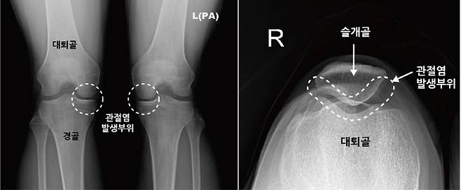 무릎관절염(좌)-슬개대퇴관절염(우) 발생 부위 비교. 사진 바른세상병원 제공.