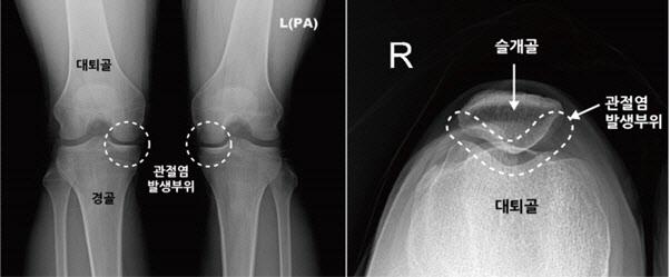 무릎관절염(왼쪽)-슬개대퇴관절염(오른쪽) 부위 비교. 바른세상병원 제공