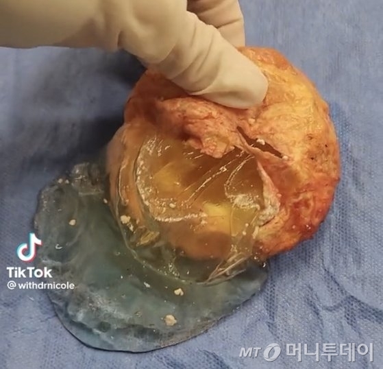 미국 오클라호마주의 성형외과 의사가 공유한 영상 /사진=니콜 카스텔리제 틱톡 영상